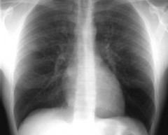 Embolia polmonare: Rivaroxaban raccomandato per l’approvazione Ue