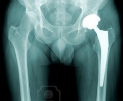 Protesi anca: cosa fare se si è a rischio