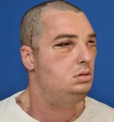 Trapianto di volto totale: miracolo negli Usa