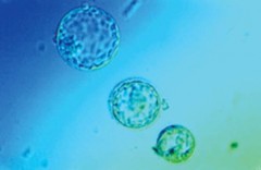 Cellule staminali: trapianto di vena su una bambina