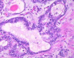 Tumori stromali gastrointestinali Gist: sintomi, cure e farmaci efficaci