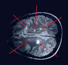 Sclerosi multipla: sintomi, cure e diagnosi