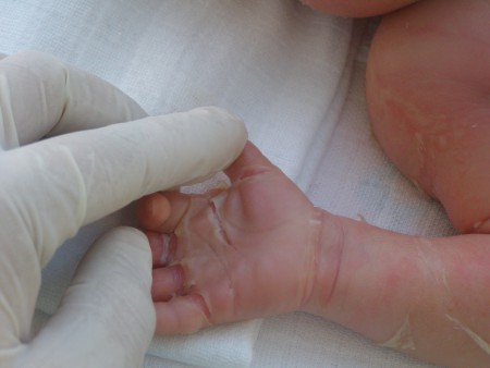 Bambina di plastica nata in India ha una malattia rara