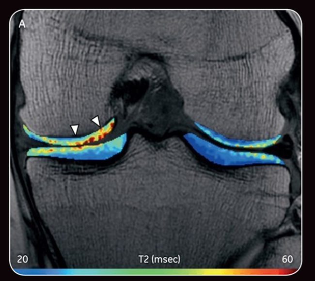 2D image - knee cartilage degeneration color overlay